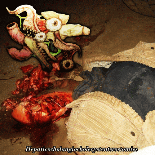 Hepaticocholangiocholecystenterostomies